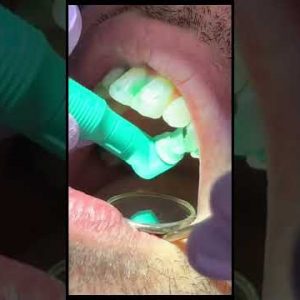 teeth cleaning at the dentist step by step #shorts