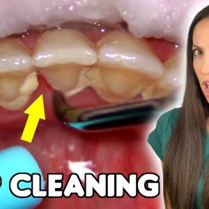 Deep Cleaning With HEAVY Tartar Build Up At The Dentist