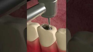 hidden cavity under tooth #shorts (tooth decay filling procedure)