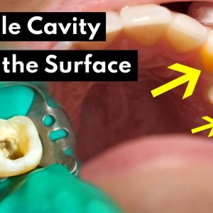 How Dentists Treat INVISIBLE CAVITIES