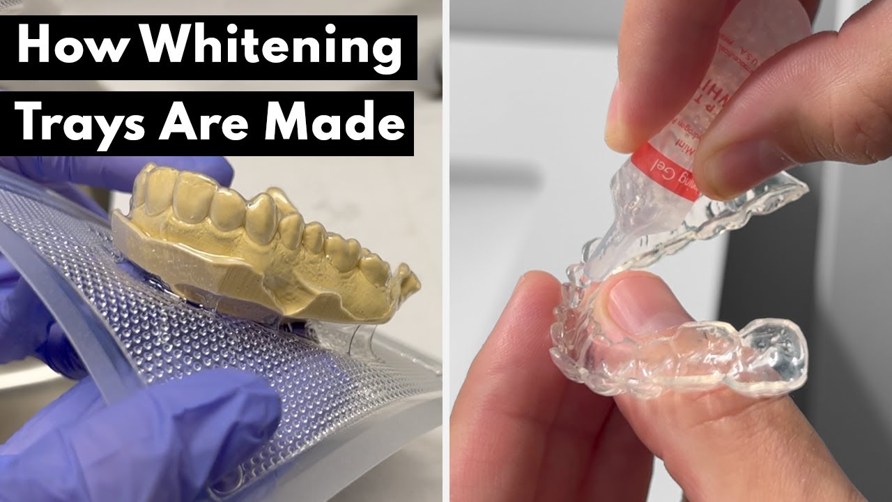 How Whitening Trays Are Made At The Dentist Etoners
