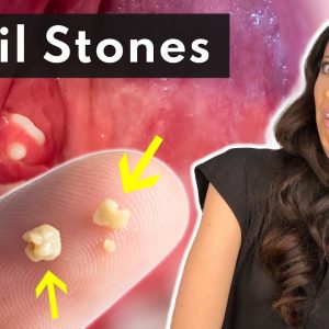 What Are Tonsil Stones & How To SAFELY Remove Them