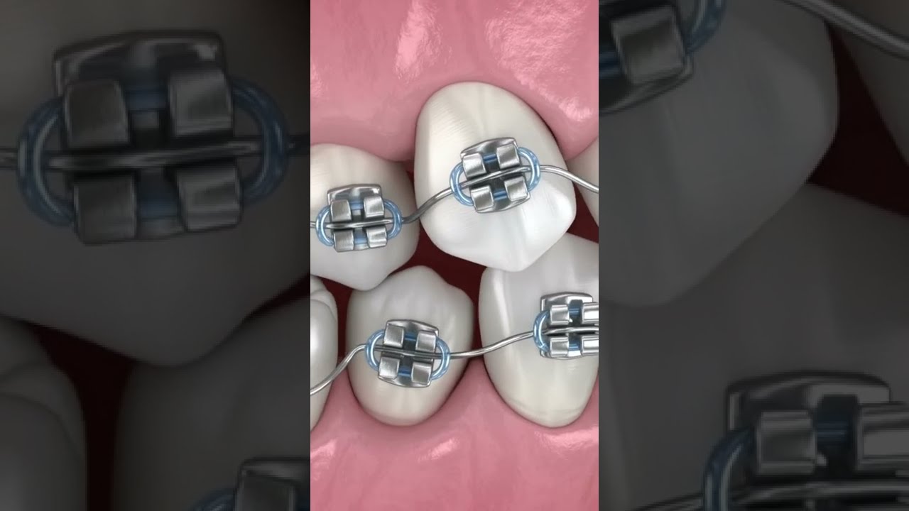 Braces Procedure How Braces Work Shorts Etoners