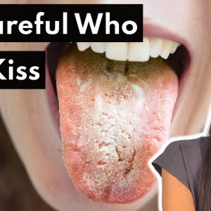 Can You Get A Yeast Infection In Your Mouth?!