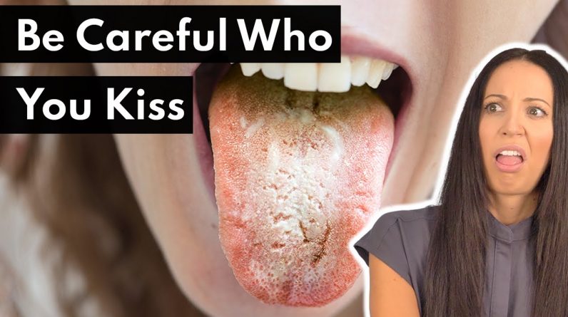 Can You Get A Yeast Infection In Your Mouth?!