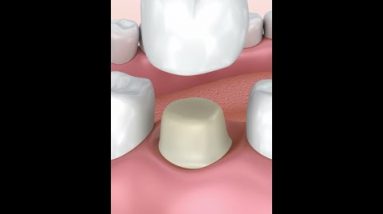 dental crown procedure #shorts