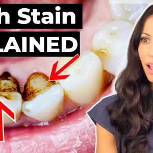 Dental Hygienist EXPLAINS Why Teeth Stain
