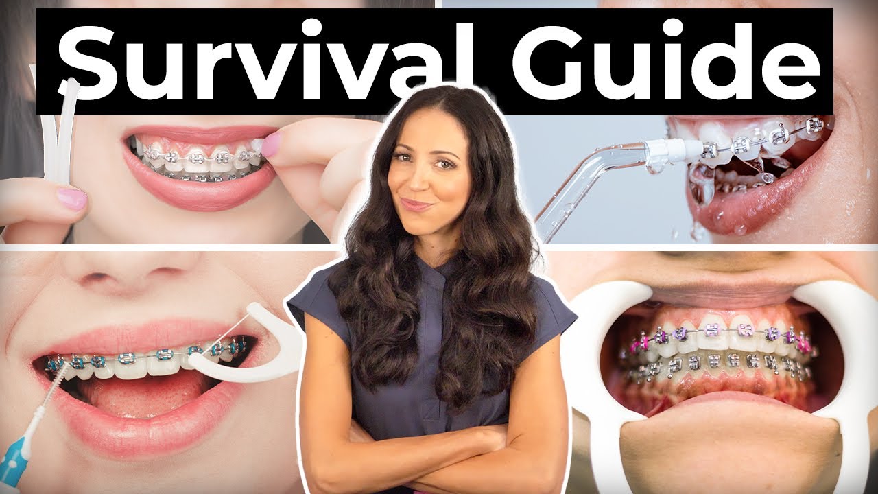 How To Prepare & What To Expect With BRACES Etoners