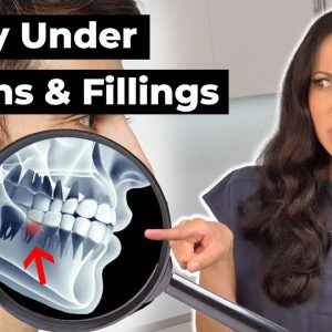 Tooth Decay Under a Crown | Recurrent Decay Explained