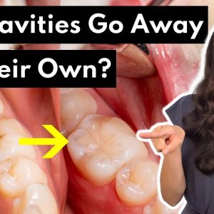 Wait, Can Cavities Go Away on Their Own?
