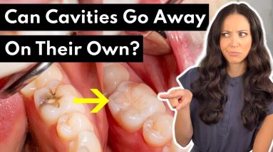 Wait, Can Cavities Go Away on Their Own?