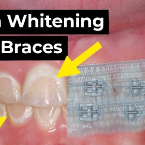 Can You Whiten Your Teeth With Braces?!