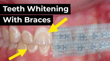 Can You Whiten Your Teeth With Braces?!