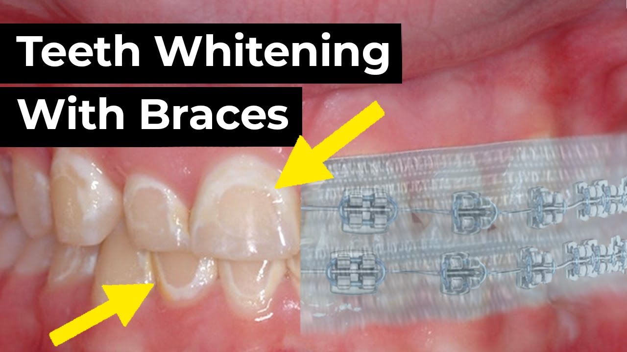 Can You Whiten Your Teeth With Braces?! - Etoners