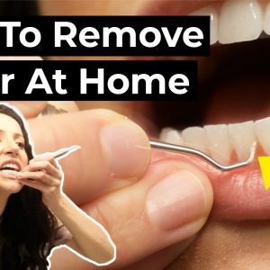 Is it Possible To Remove Tartar At Home