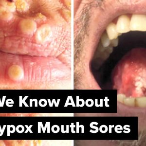Monkeypox Mouth Sores