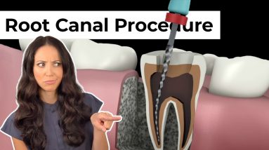 Root Canal Procedure Step by Step