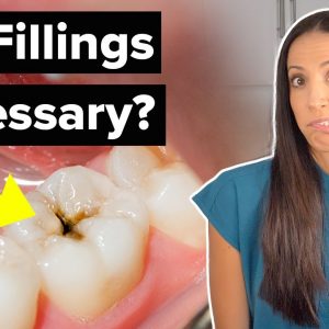 do you REALLY need to get a CAVITY filled?