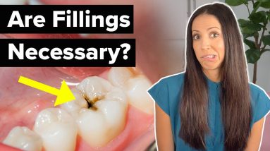 do you REALLY need to get a CAVITY filled?