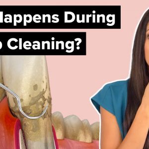 What Happens During a Deep Cleaning Procedure (Scaling and Root Planing)