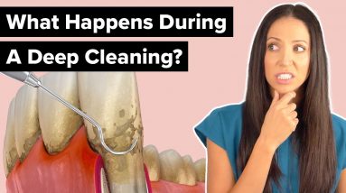 What Happens During a Deep Cleaning Procedure (Scaling and Root Planing)