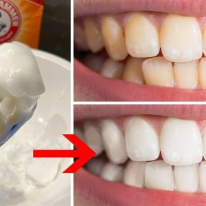 Teeth Whitening Home Remedies & DIY Hacks (Fast, Natural, & Affordable White Teeth)