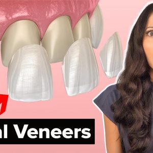 Dental Veneers Procedure Explained