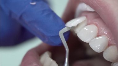 dental veneers procedure #shorts