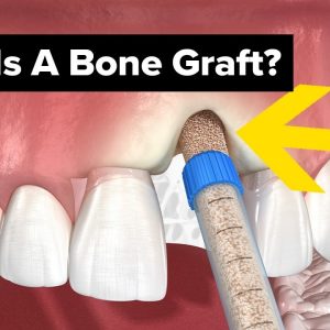 Dental Bone Grafts Explained