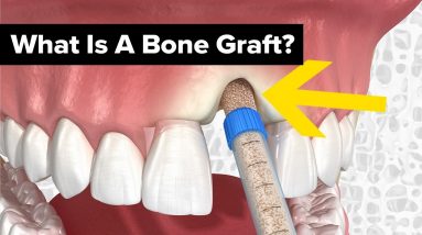 Dental Bone Grafts Explained