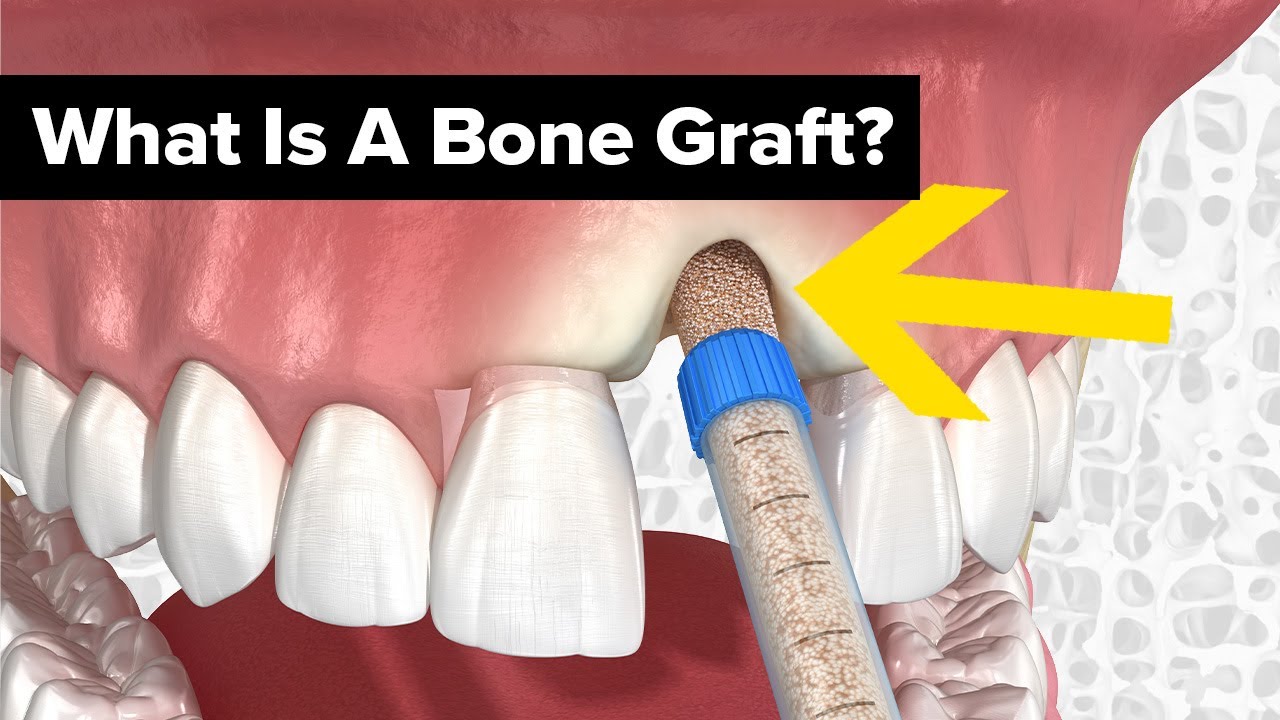 Dental Bone Grafts Explained Etoners