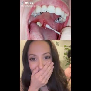 Dental Hygienist Reacts To Tonsil Stone Removal!