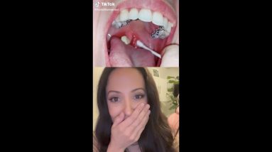 Dental Hygienist Reacts To Tonsil Stone Removal!