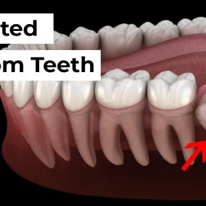 Impacted Wisdom Tooth Removal