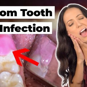 what does this SWOLLEN gum flap mean? (Pericoronitis Explained)