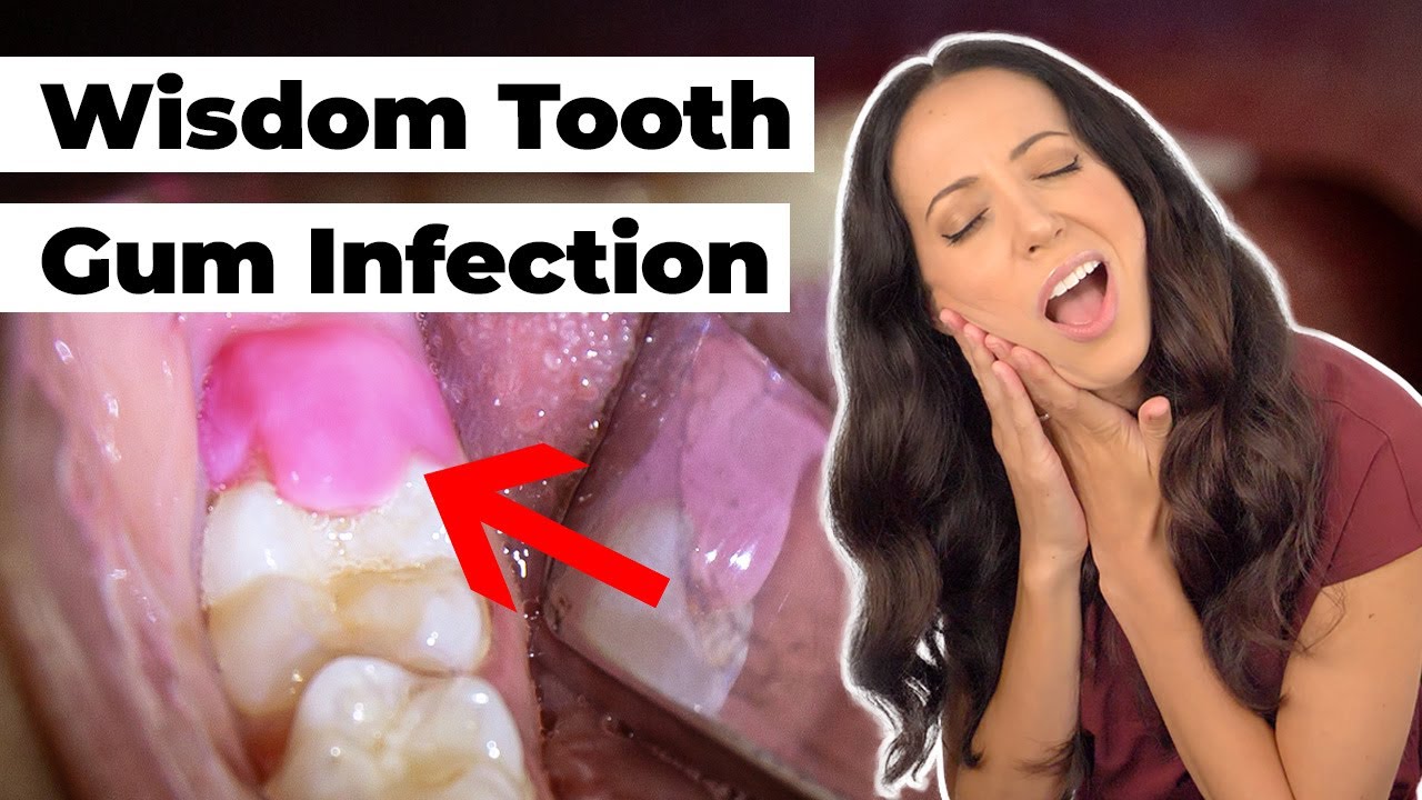 what-does-this-swollen-gum-flap-mean-pericoronitis-explained-etoners