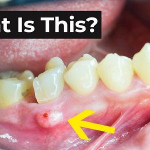 What is an Abscessed Tooth & What To Do About It