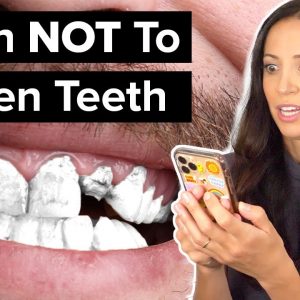 5 Reasons You Should NOT Whiten Your Teeth