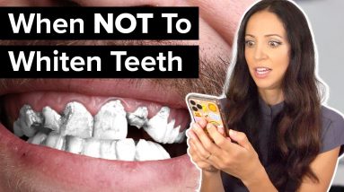 5 Reasons You Should NOT Whiten Your Teeth