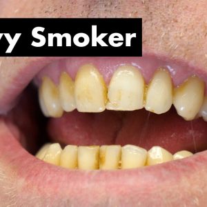 Cleaning Smoker's Teeth with Heavy Stain | Teeth Cleaning