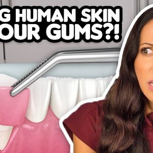 Gum Grafts Explained
