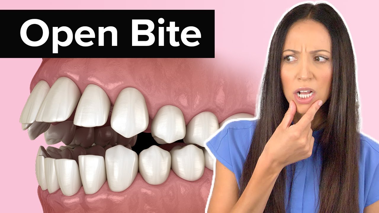 What's An Open Bite? Etoners