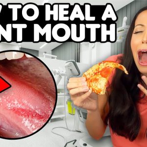 6 QUICK ways to HEAL a BURNT MOUTH