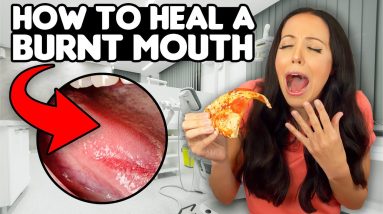 6 QUICK ways to HEAL a BURNT MOUTH