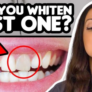 Can You Whiten One Tooth?