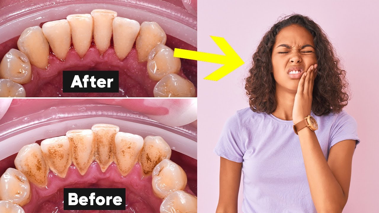 Deep Teeth Cleaning Recovery Tips How To Heal Fast NG0KHRNHqoI 