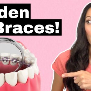 Dirty Secrets of Lingual Braces (The Braces You Can't See!)