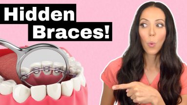Dirty Secrets of Lingual Braces (The Braces You Can't See!)