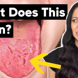 What Does a Cracked Tongue Mean?