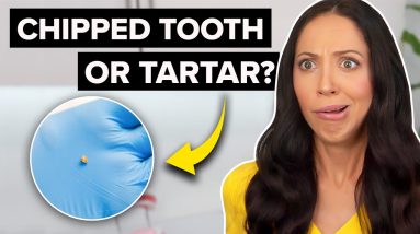 Did I Just CHIP My Tooth or Was It Tartar?